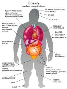 Obesity and Complications